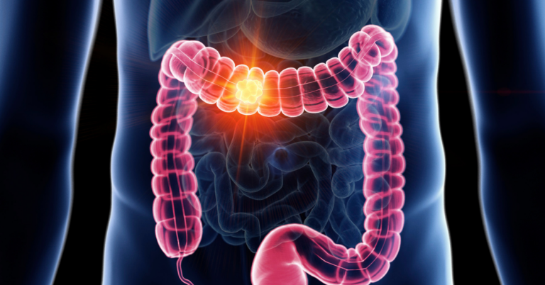 Câncer de Intestino: Sintomas, Diagnóstico e Tratamento em Campo Grande e Dourados