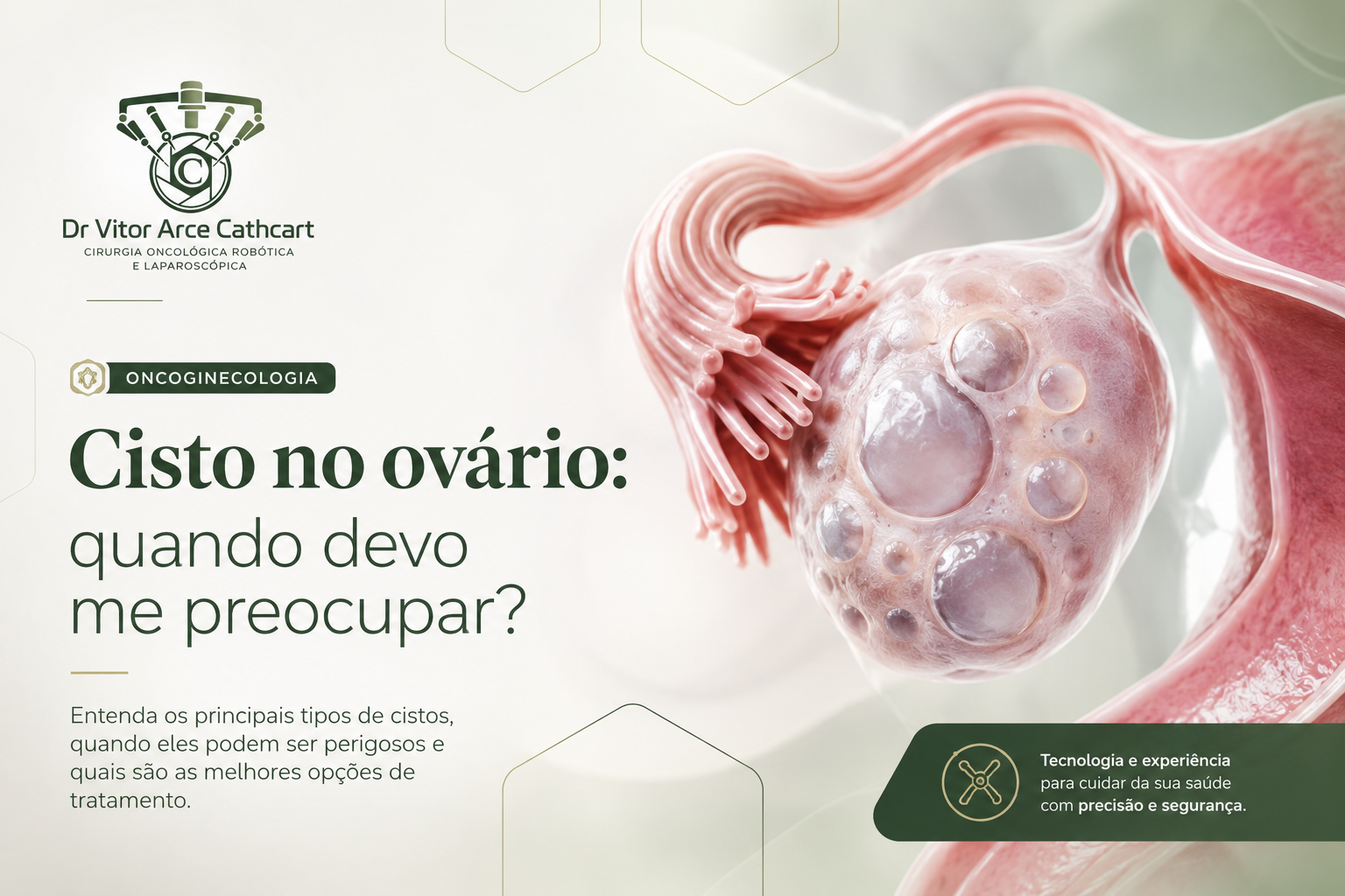 Ilustração médica mostrando um ovário com múltiplos cistos, utilizada para explicar os diferentes tipos de cistos ovarianos, quando eles merecem investigação e sua relação com o câncer de ovário.