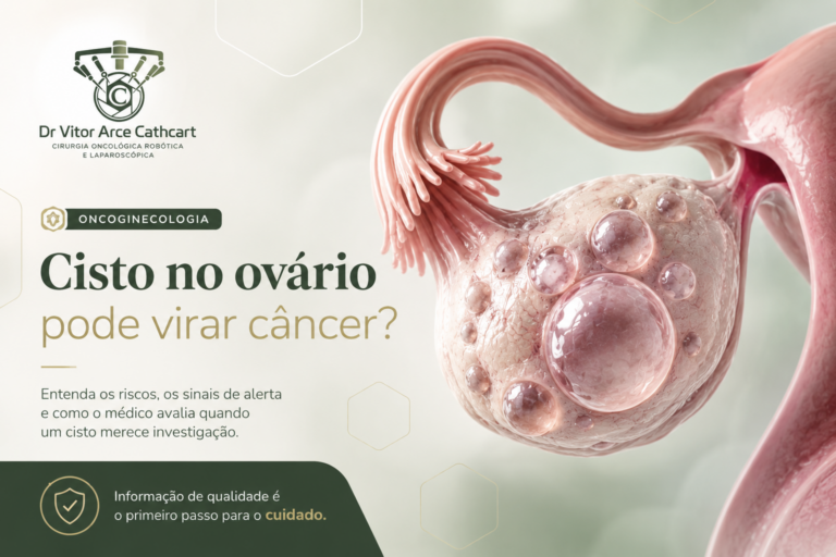 Ilustração médica de um ovário com múltiplos cistos utilizada para explicar quando um cisto no ovário pode estar associado ao câncer, quais características aumentam a suspeita de malignidade e como é realizada a investigação.